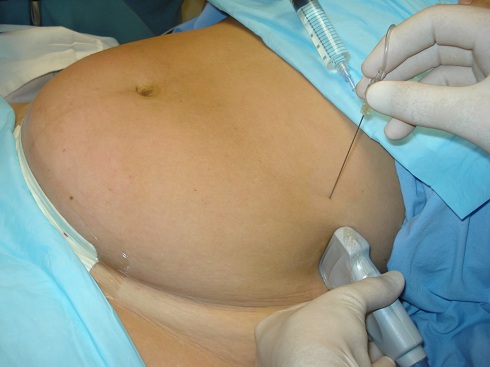 Probe and needle positioning during an ultrasound-guided TAP block.
