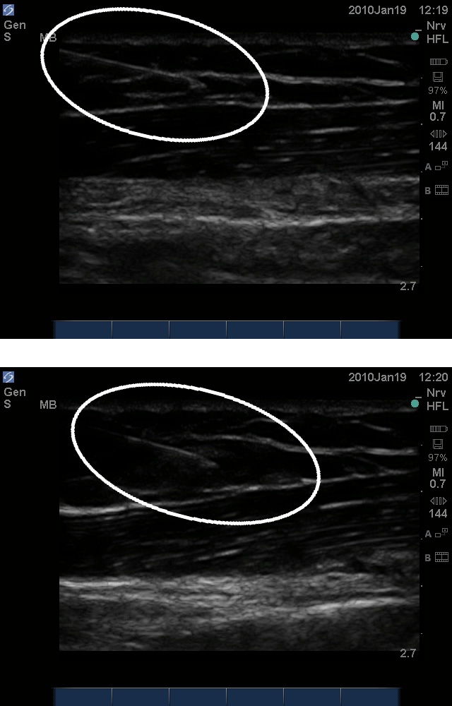 hydrolocation with in-plane approach