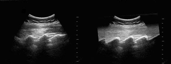 sacrum in longitudinal plane