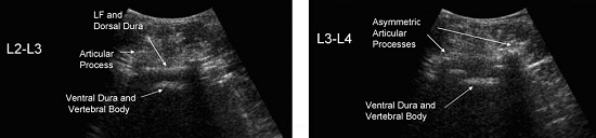 sonogram of interspace in transverse plane with scoliosis