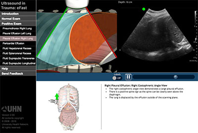 Positive Exam: Pleural Effusion of the Right Lung