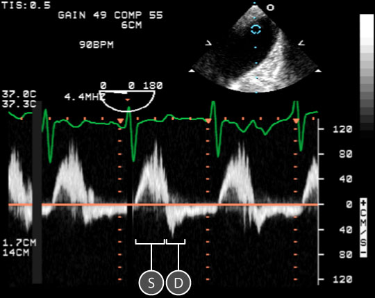 pulse wave spectral doppler of Mitral Valve