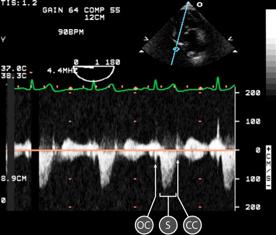 pulse wave spectral doppler of Mitral Valve