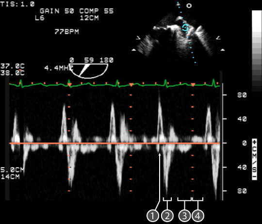 pulse wave spectral doppler of Mitral Valve