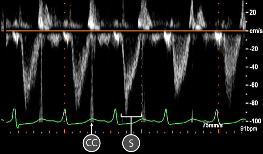 pulse wave spectral doppler of Mitral Valve