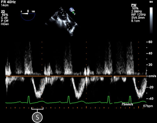 pulsed wave spectral doppler of pulmonary valve