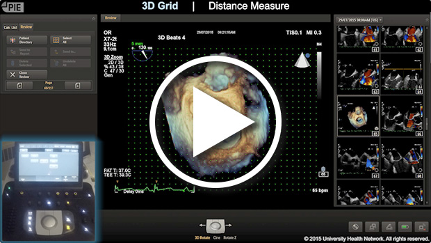 Philips Epiq 7 - Basic Measurements of 3D Datasets