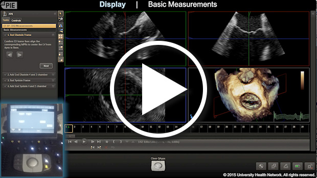 Philips Epiq 7 - Multiplanar Reconstruction