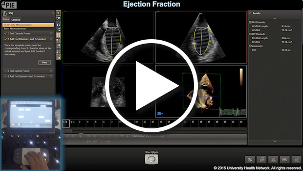 Philips Epiq 7 - MPR Left Ventricle Measurements