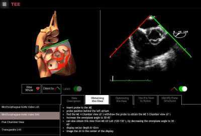 Aortic Valve TEE