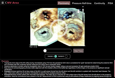 Mitral Stenosis Planimetry