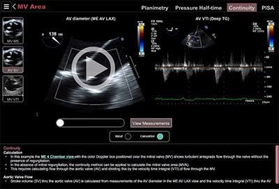 Mitral Stenosis Continuity