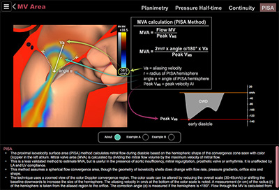 Mitral Stenosis PISA