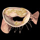 Mitral Valve Stenosis image