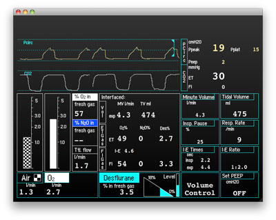 Anesthetic Ventilator/Gas Machine