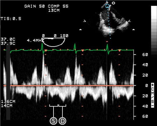 pulse wave spectral doppler of Mitral Valve