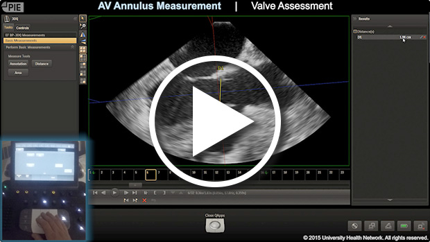 Philips Epiq 7 - MPR Aortic Valve Measurements