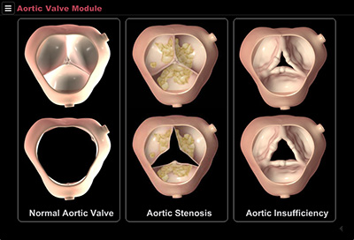 Aortic Valve menu