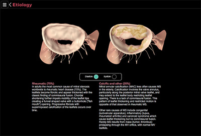 Mitral Stenosis Etiology