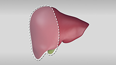 Hepatectomy procedure